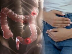 Sobat Idaman Banjarbaru, Waspada Kanker Usus Besar